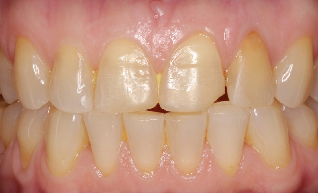 Циркониевые коронки. Цифровая 3D-стоматология.