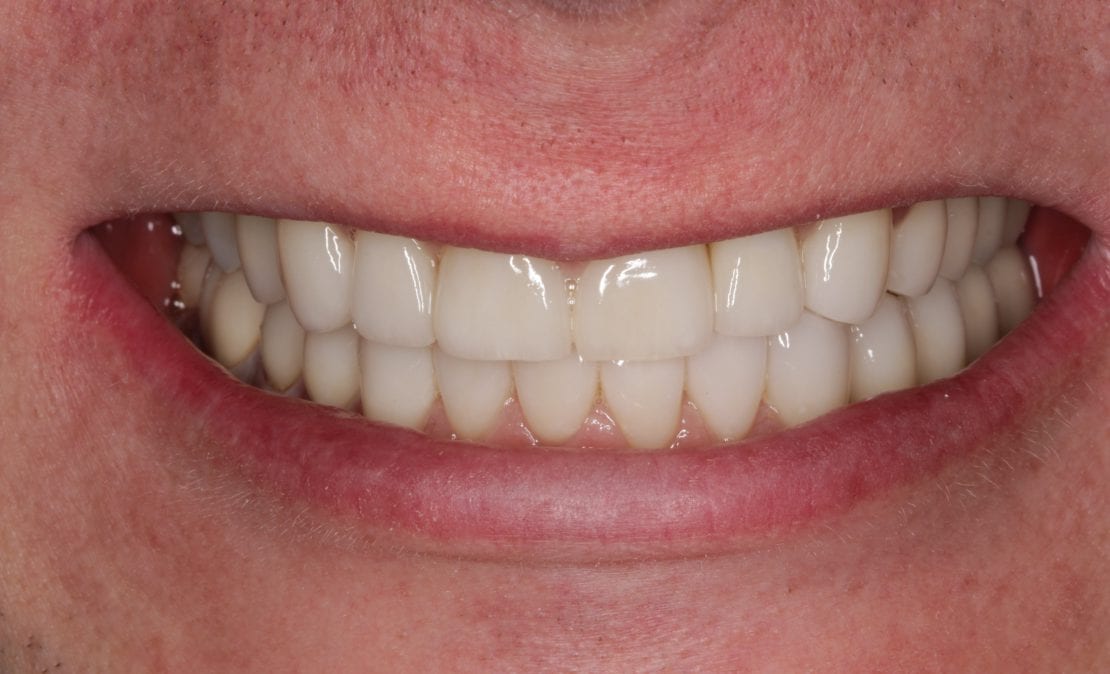 Имплантация зубов, безметалловая керамика на каркасах из циркония.
