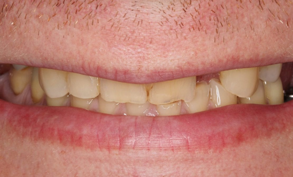 Имплантация после удаления зубов