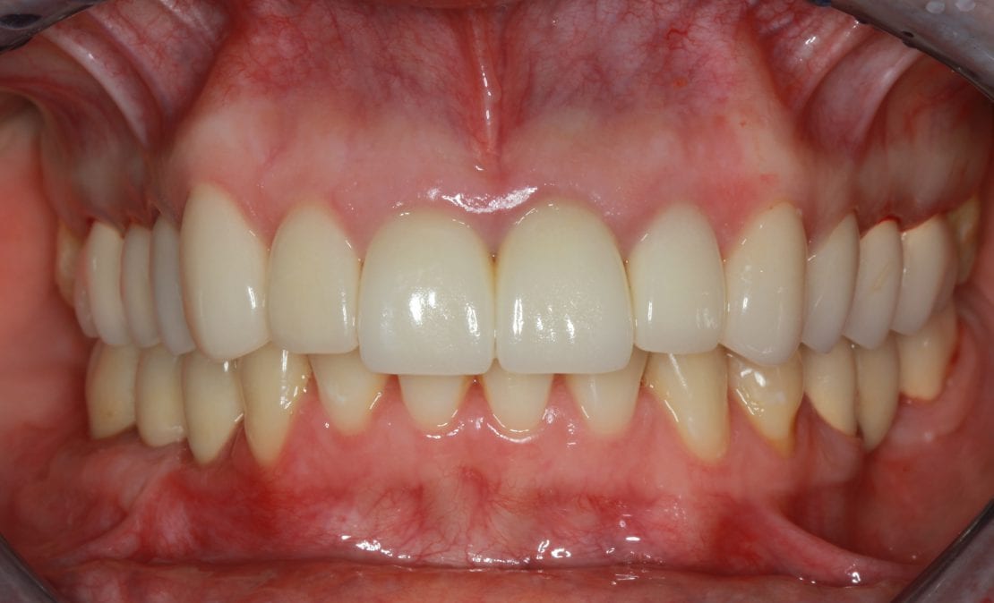 Коронки из безметалловой керамики и керамические виниры E-Max, имплантация зубов