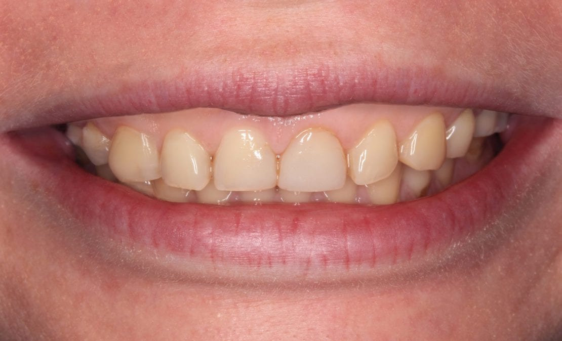Виниры и коронки из прессованной керамики E-max (Германия). Имплантация зубов.