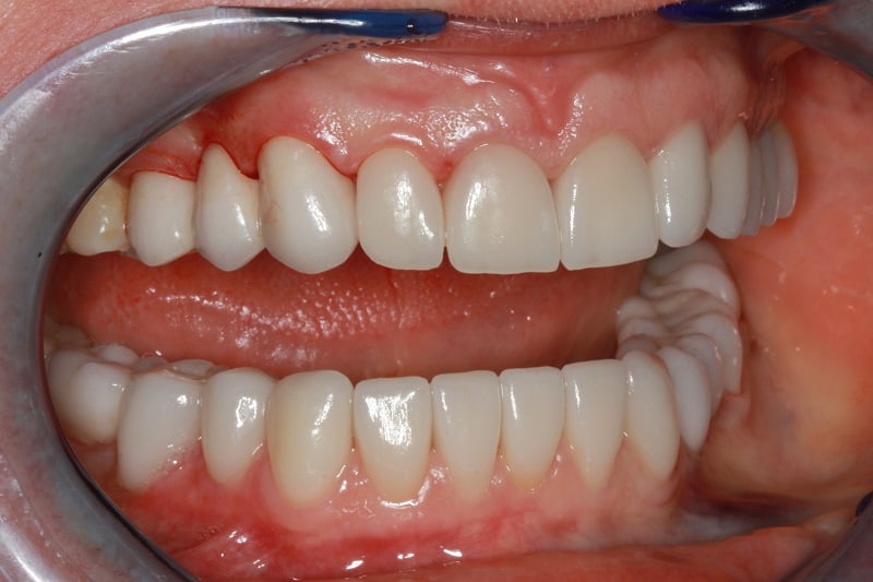 Почему пациенты предпочитают делать художественную реставрацию зубов в 