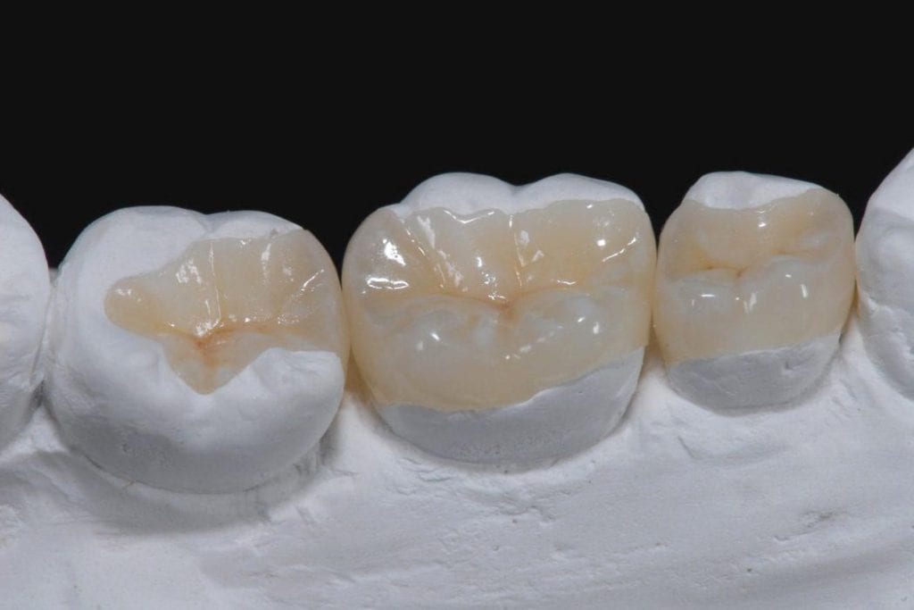 3D-вкладки - наилучший вариант реставрации жевательной группы зубов