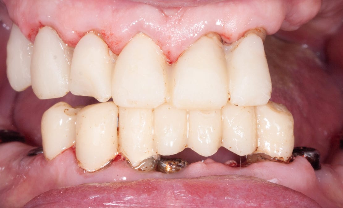 Профессиональная гигиена полости рта перед протезированием зубов