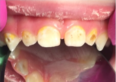 Лечение кариеса с восстановлением коронок зубов фотополимерами.