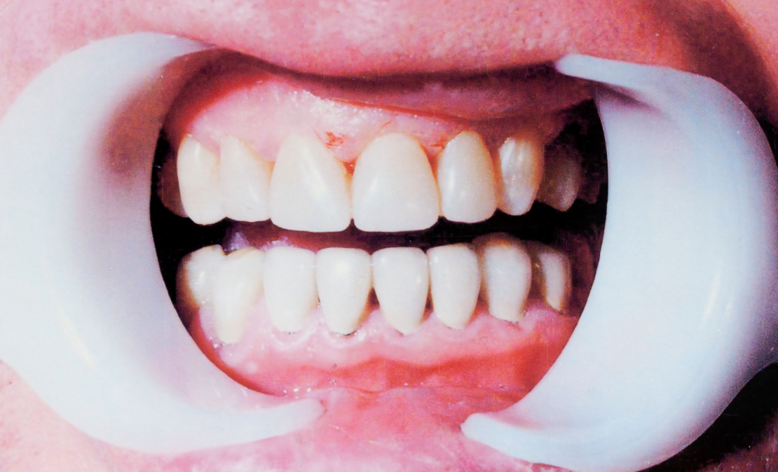 Повышенное стирание зубов (патологическая стираемость)