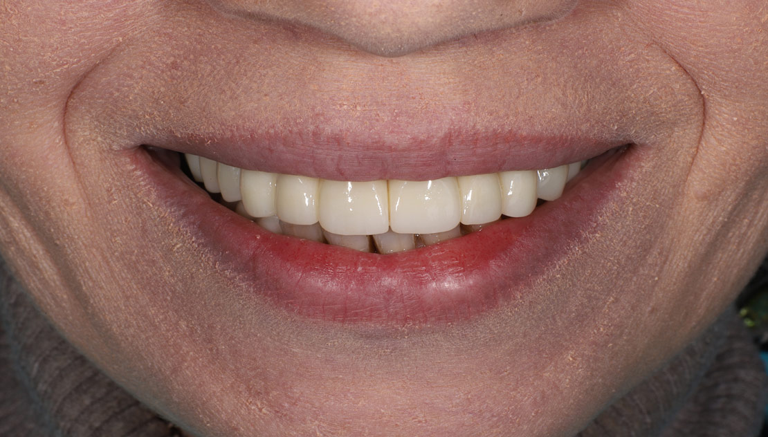 Тотальное протезирование при патологической стираемости зубов