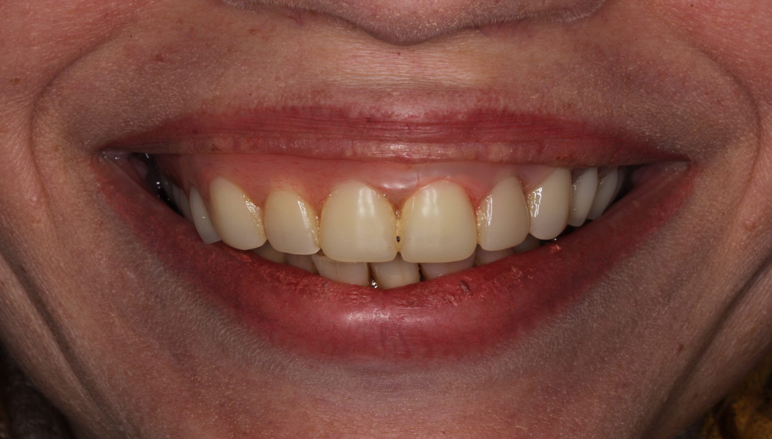 Тотальное протезирование при патологической стираемости зубов