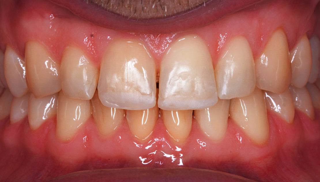 Протезирование зубов на имплантатах Xive (Германия)