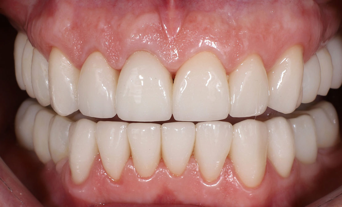 Протезирование безметалловой керамикой на зубах и имплантах Дентиум
