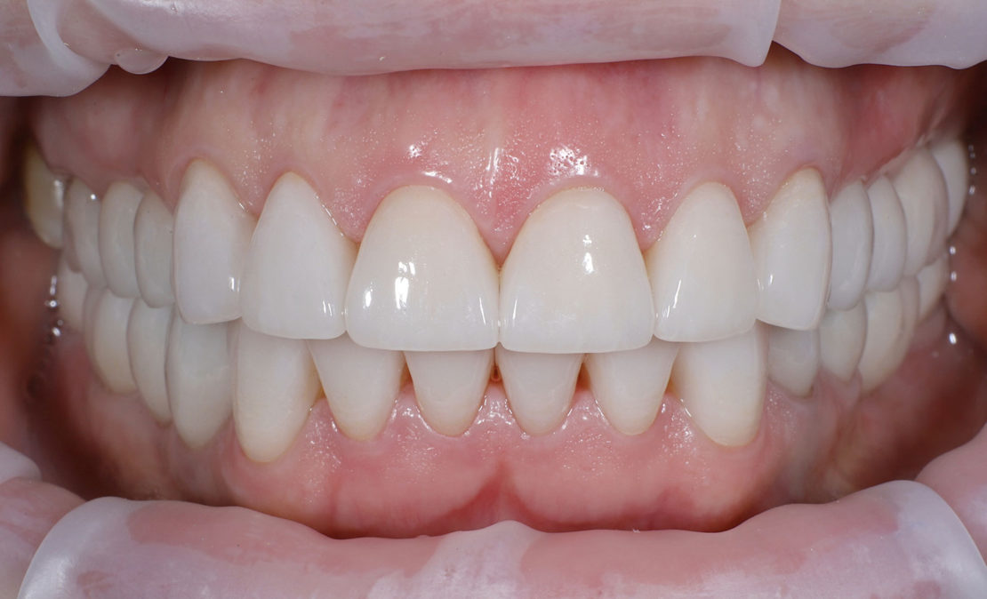 Протезирование безметалловой керамикой на зубах и имплантах Дентиум